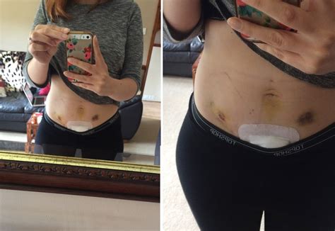 endometriosis surgery scars